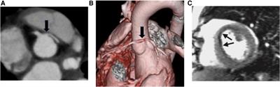 Wall motion assessment by feature tracking in pediatric patients with coronary anomalies undergoing dobutamine stress CMR